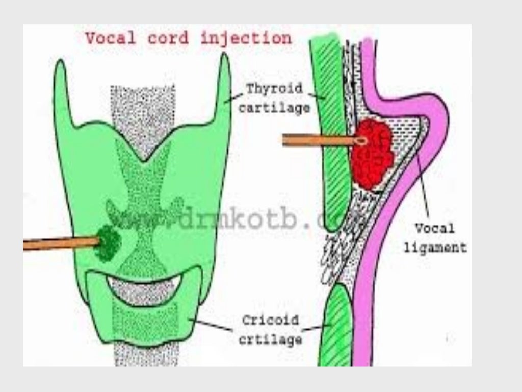 Recurrent laryngeal nerve paralysis
