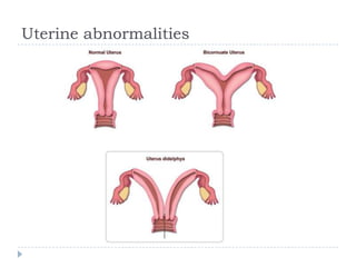 Uterine abnormalities
 