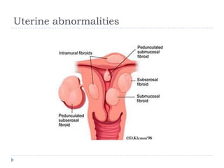 Uterine abnormalities
 