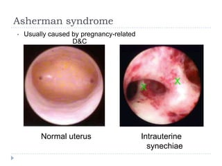Asherman syndrome
Normal uterus
• Usually caused by pregnancy-related
D&C
Intrauterine
synechiae
 