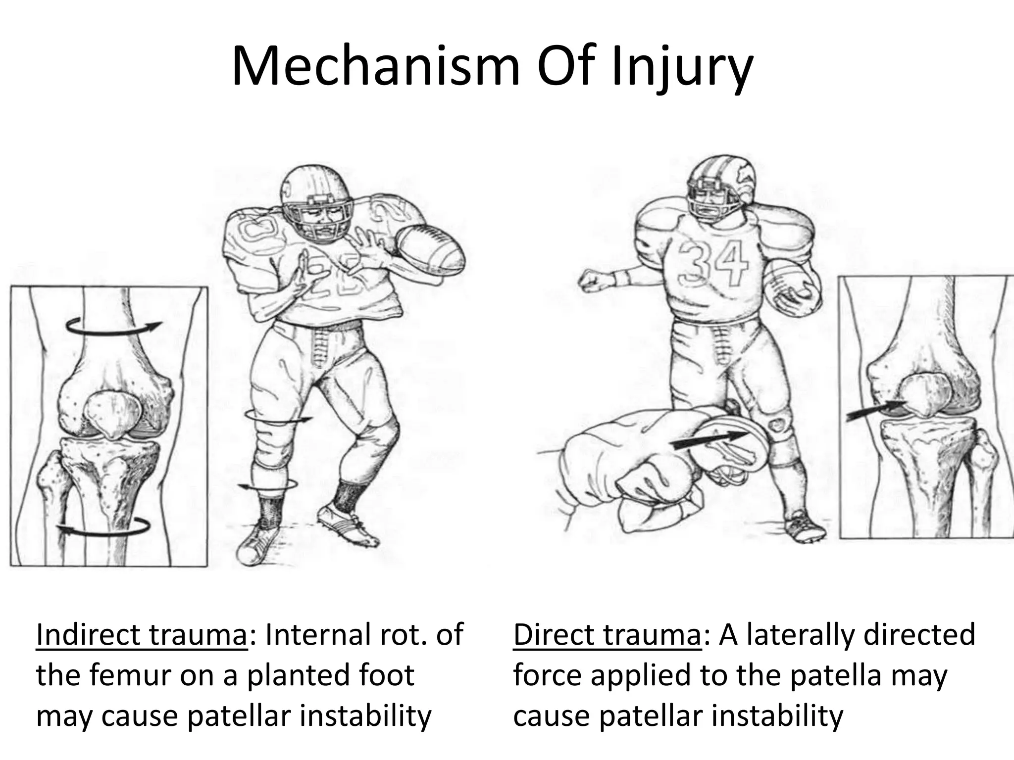Mechanism Of Injury
Indirect trauma: Internal rot. of
the femur on a planted foot
may cause patellar instability
Direct trauma: A laterally directed
force applied to the patella may
cause patellar instability
 