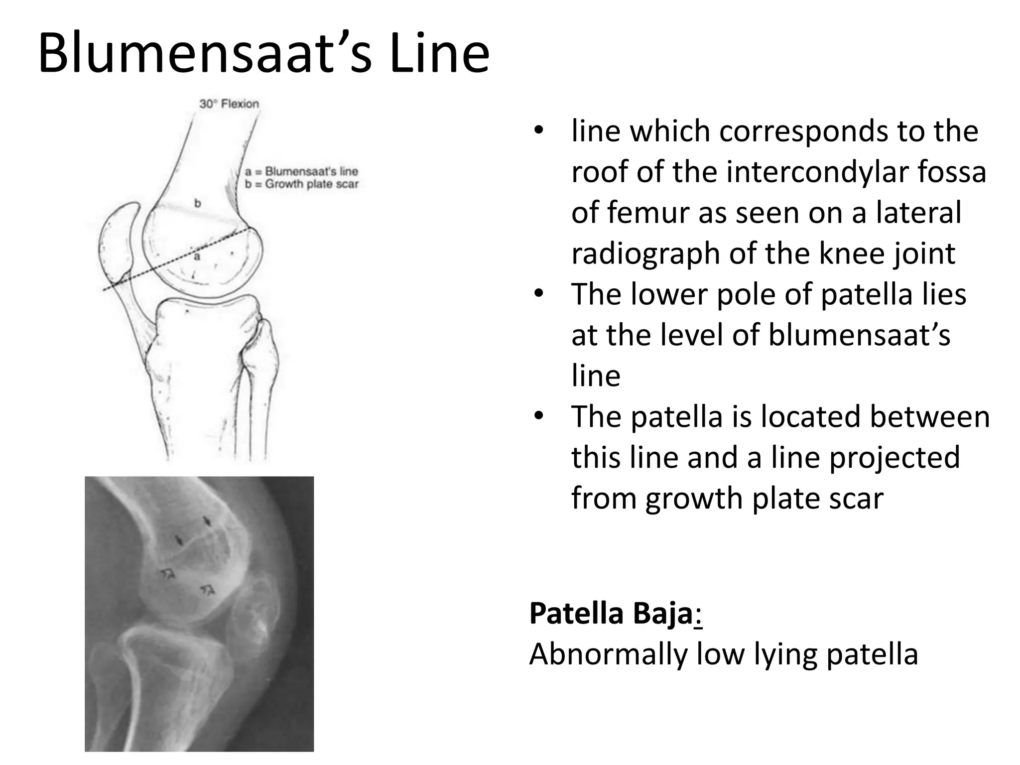 Blumensaat’s Line
• line which corresponds to the
roof of the intercondylar fossa
of femur as seen on a lateral
radiograph of the knee joint
• The lower pole of patella lies
at the level of blumensaat’s
line
• The patella is located between
this line and a line projected
from growth plate scar
Patella Baja:
Abnormally low lying patella
 