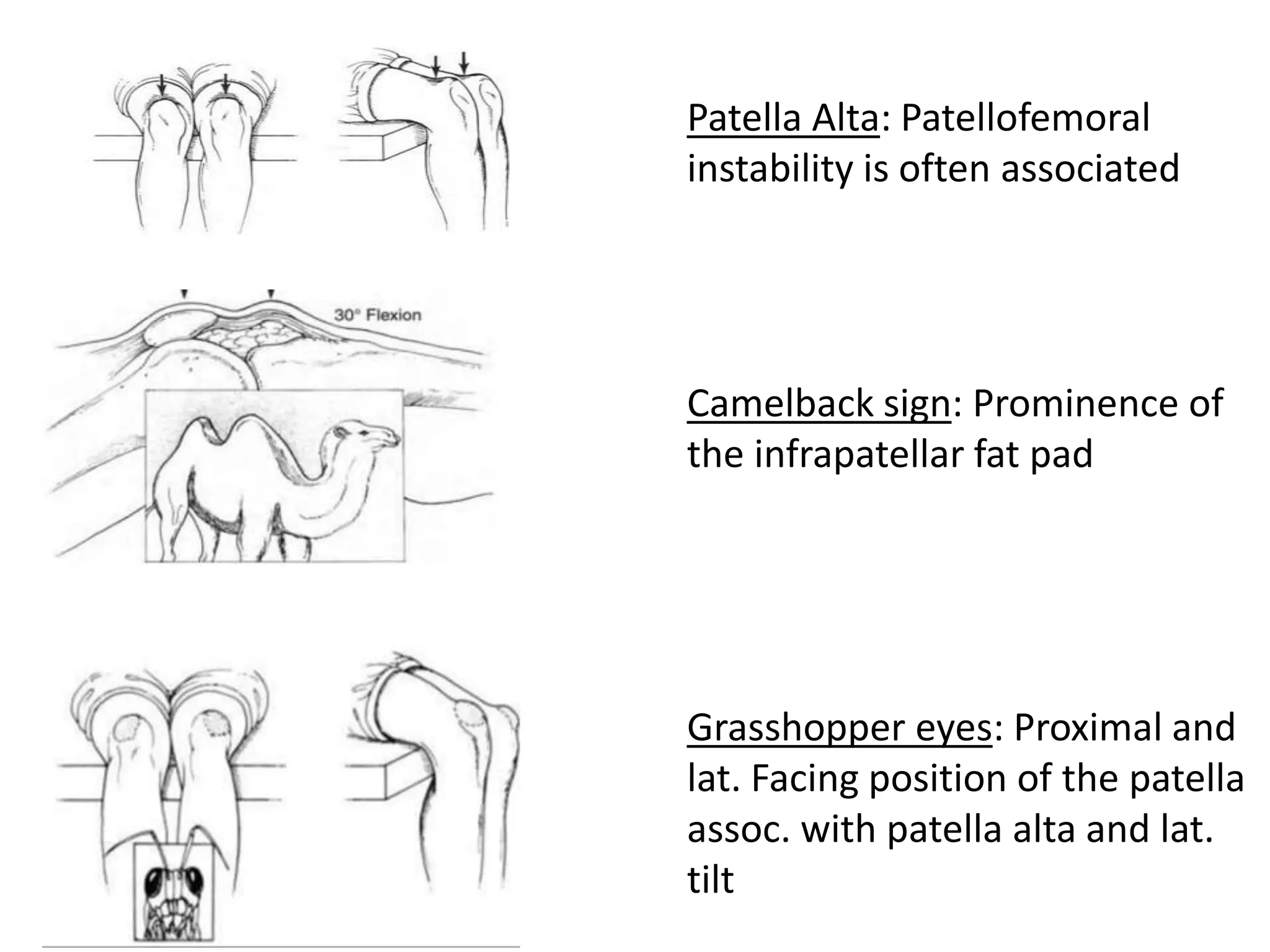 Patella Alta: Patellofemoral
instability is often associated
Camelback sign: Prominence of
the infrapatellar fat pad
Grasshopper eyes: Proximal and
lat. Facing position of the patella
assoc. with patella alta and lat.
tilt
 
