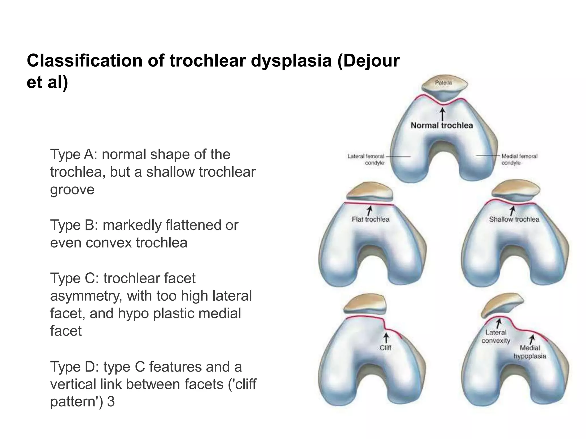 Type A: normal shape of the
trochlea, but a shallow trochlear
groove
Type B: markedly flattened or
even convex trochlea
Type C: trochlear facet
asymmetry, with too high lateral
facet, and hypo plastic medial
facet
Type D: type C features and a
vertical link between facets ('cliff
pattern') 3
Classification of trochlear dysplasia (Dejour
et al)
 