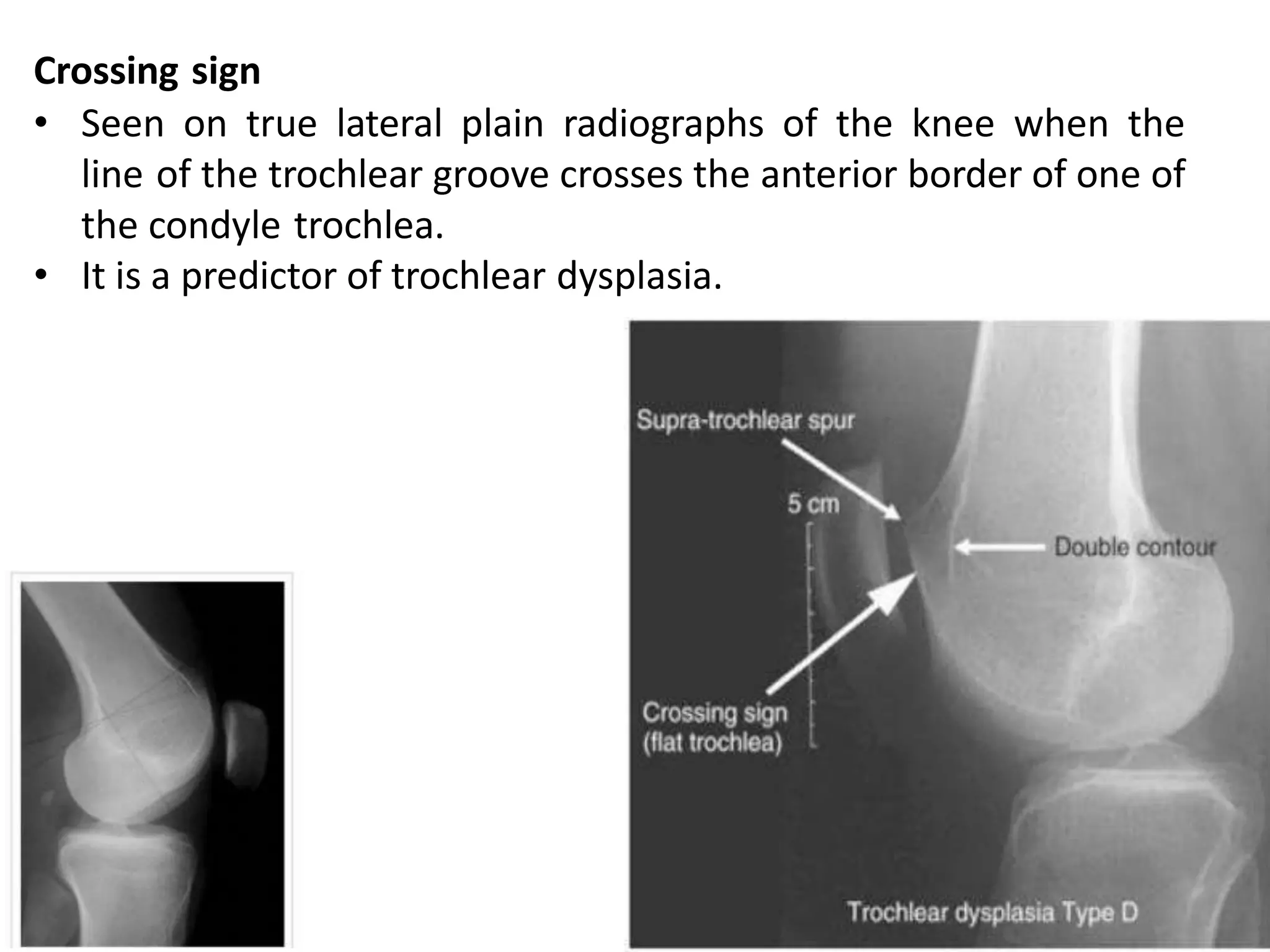 Crossing sign
• Seen on true lateral plain radiographs of the knee when the
line of the trochlear groove crosses the anterior border of one of
the condyle trochlea.
• It is a predictor of trochlear dysplasia.
 