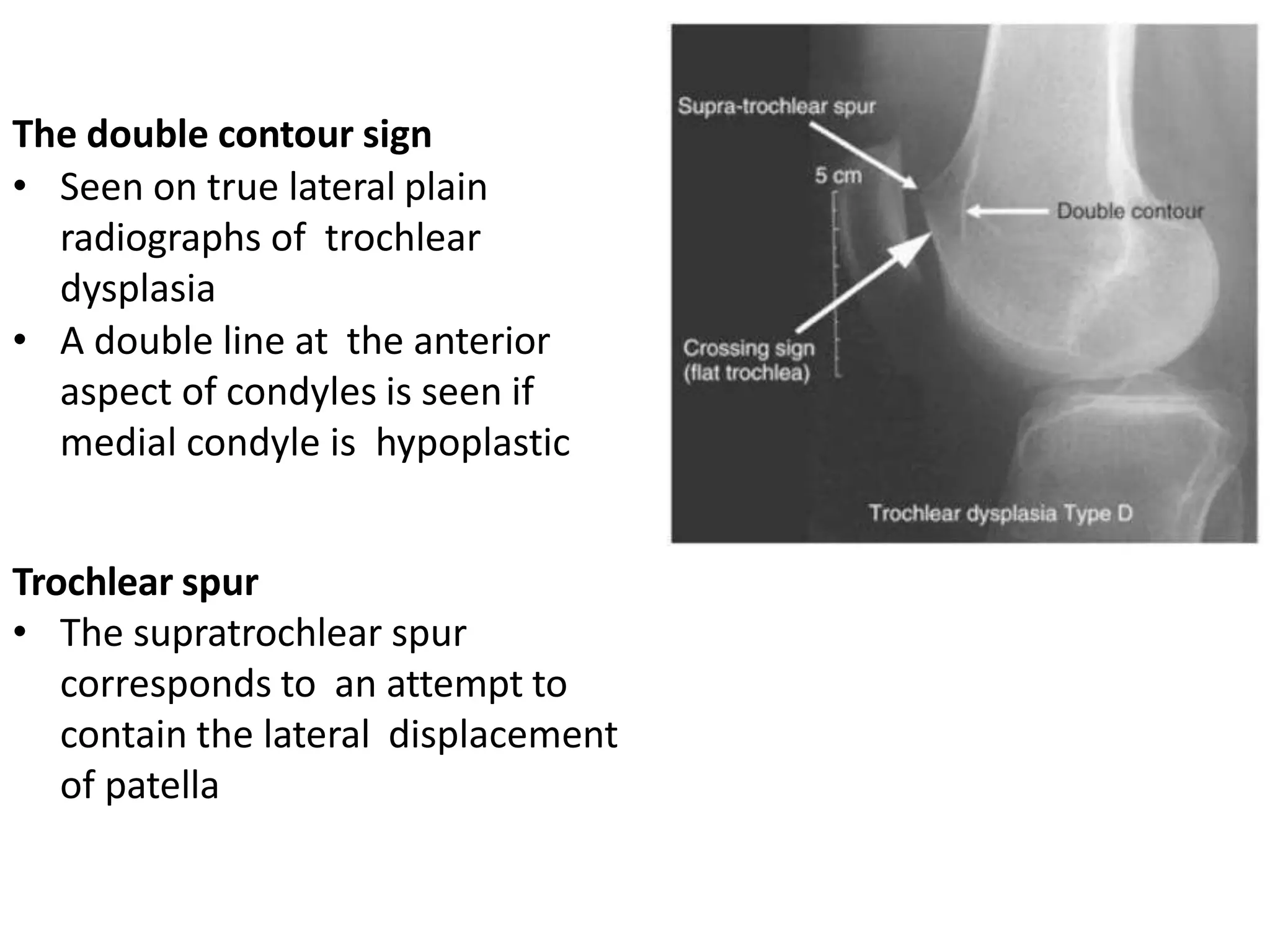 The double contour sign
• Seen on true lateral plain
radiographs of trochlear
dysplasia
• A double line at the anterior
aspect of condyles is seen if
medial condyle is hypoplastic
Trochlear spur
• The supratrochlear spur
corresponds to an attempt to
contain the lateral displacement
of patella
 