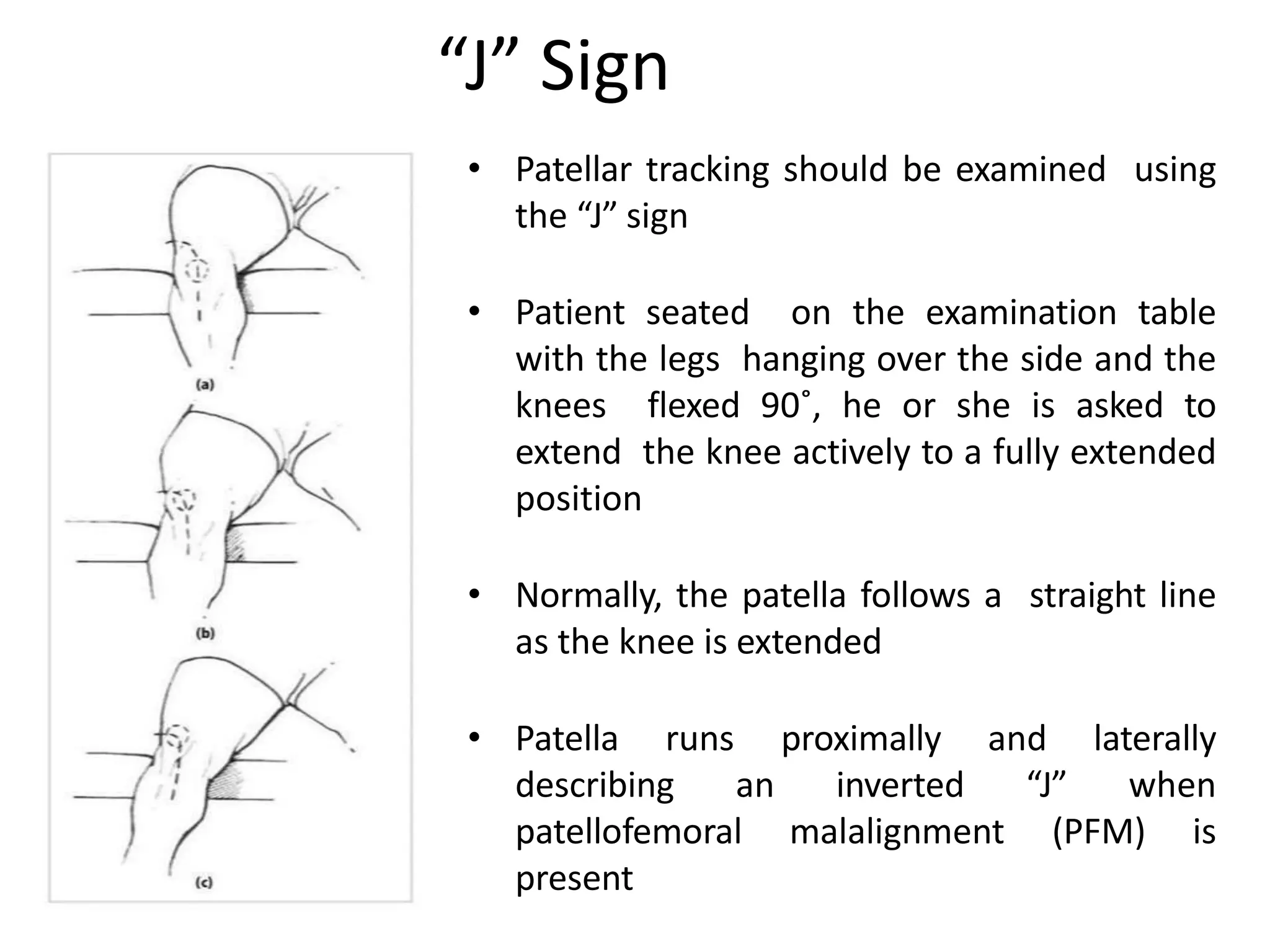 • Patellar tracking should be examined using
the “J” sign
• Patient seated on the examination table
with the legs hanging over the side and the
knees flexed 90˚, he or she is asked to
extend the knee actively to a fully extended
position
• Normally, the patella follows a straight line
as the knee is extended
• Patella runs proximally and laterally
describing an inverted “J” when
patellofemoral malalignment (PFM) is
present
“J” Sign
 