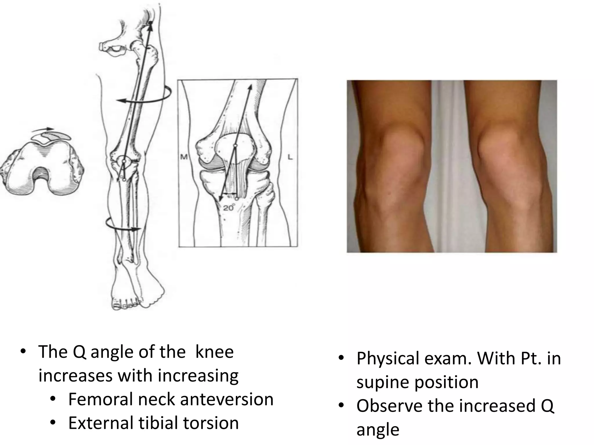 • The Q angle of the knee
increases with increasing
• Femoral neck anteversion
• External tibial torsion
• Physical exam. With Pt. in
supine position
• Observe the increased Q
angle
 