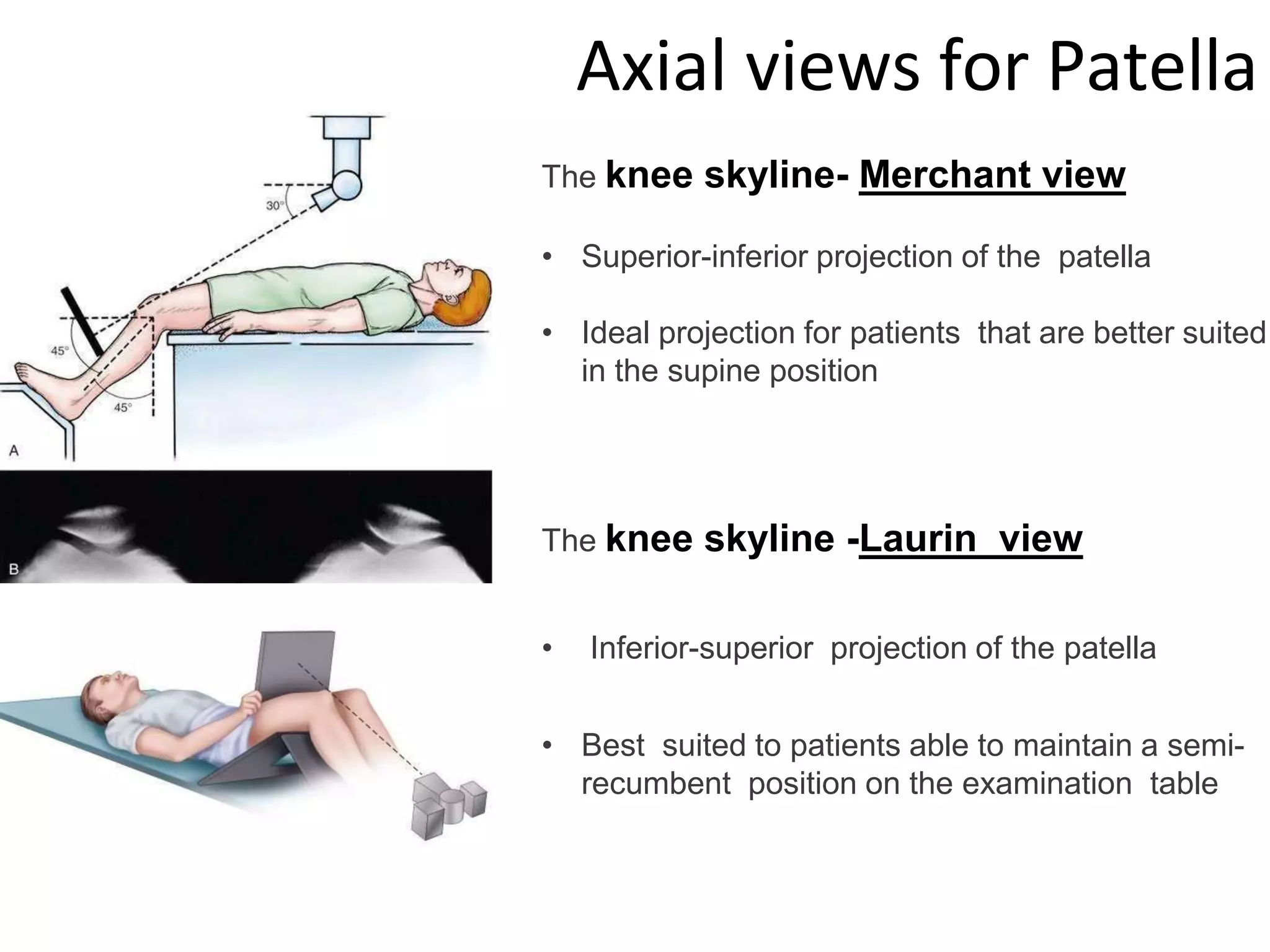 The knee skyline- Merchant view
• Superior-inferior projection of the patella
• Ideal projection for patients that are better suited
in the supine position
The knee skyline -Laurin view
• Inferior-superior projection of the patella
• Best suited to patients able to maintain a semi-
recumbent position on the examination table
Axial views for Patella
 