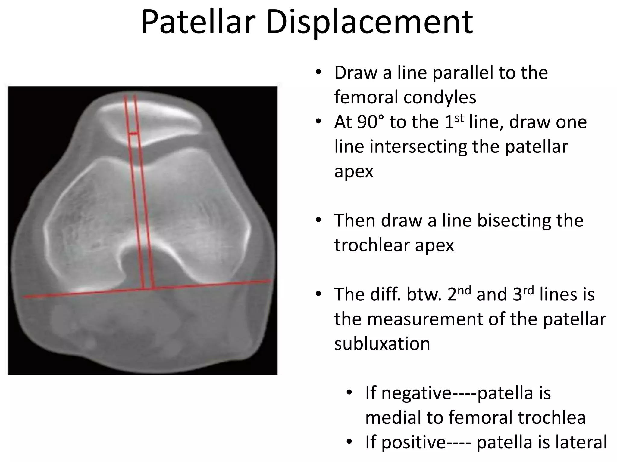 Patellar Displacement
• Draw a line parallel to the
femoral condyles
• At 90° to the 1st line, draw one
line intersecting the patellar
apex
• Then draw a line bisecting the
trochlear apex
• The diff. btw. 2nd and 3rd lines is
the measurement of the patellar
subluxation
• If negative----patella is
medial to femoral trochlea
• If positive---- patella is lateral
 