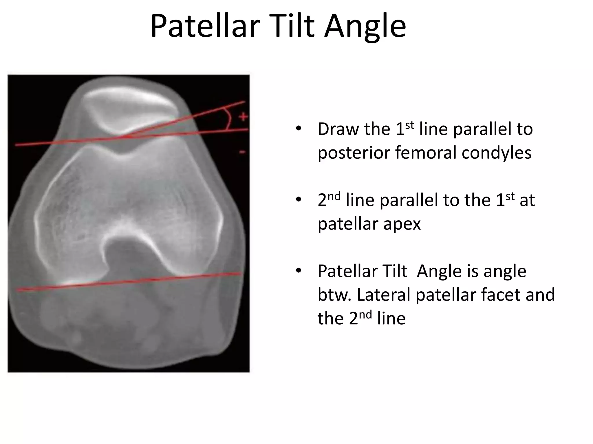 Patellar Tilt Angle
• Draw the 1st line parallel to
posterior femoral condyles
• 2nd line parallel to the 1st at
patellar apex
• Patellar Tilt Angle is angle
btw. Lateral patellar facet and
the 2nd line
 