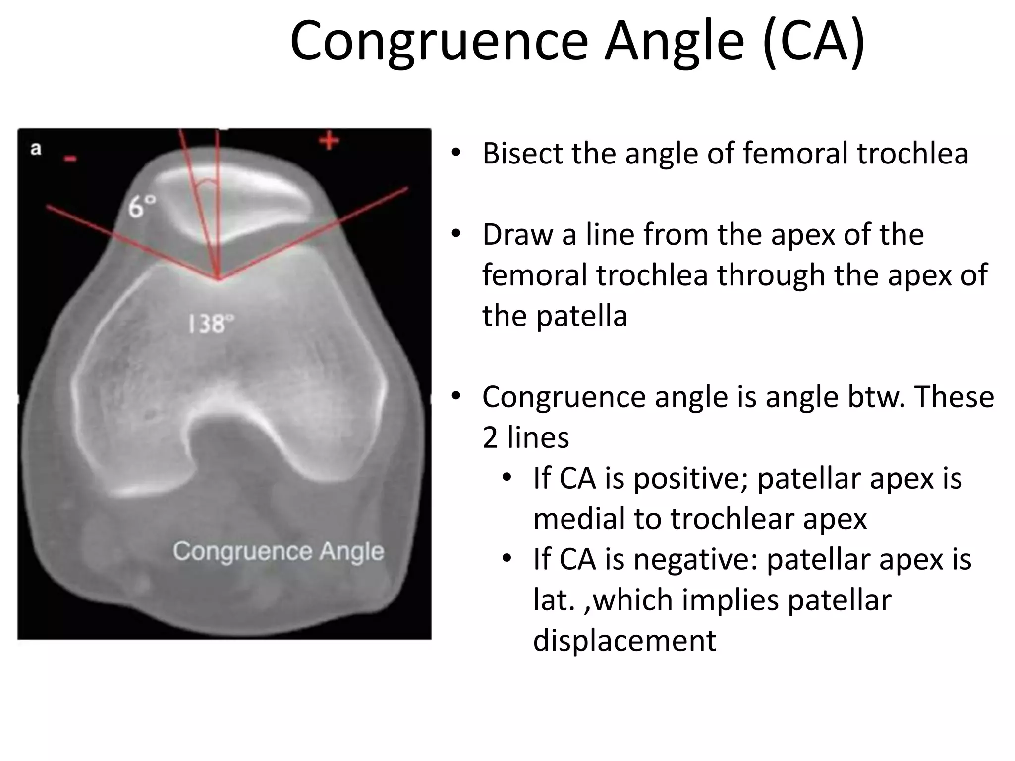 Congruence Angle (CA)
• Bisect the angle of femoral trochlea
• Draw a line from the apex of the
femoral trochlea through the apex of
the patella
• Congruence angle is angle btw. These
2 lines
• If CA is positive; patellar apex is
medial to trochlear apex
• If CA is negative: patellar apex is
lat. ,which implies patellar
displacement
 