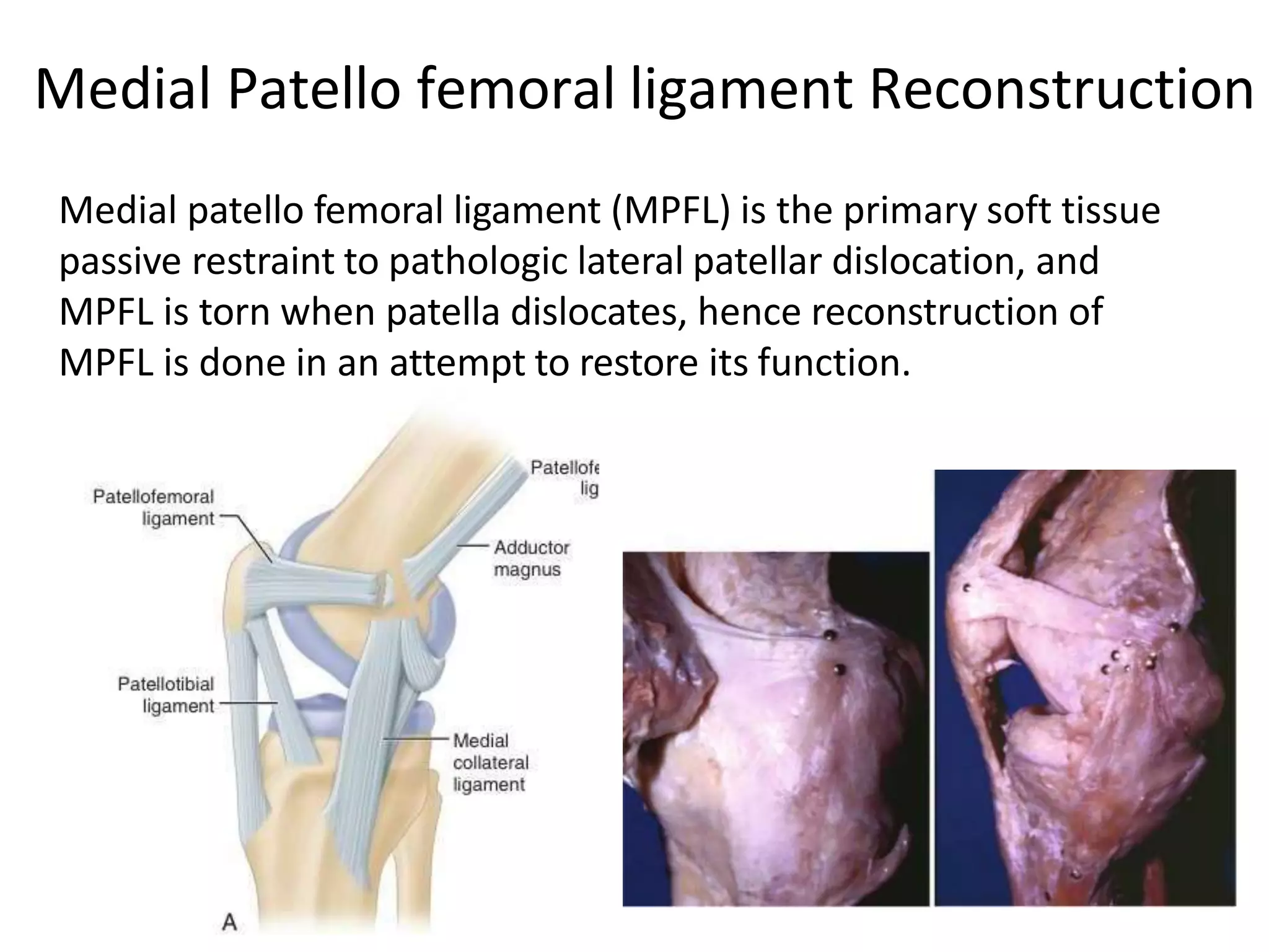 Medial patello femoral ligament (MPFL) is the primary soft tissue
passive restraint to pathologic lateral patellar dislocation, and
MPFL is torn when patella dislocates, hence reconstruction of
MPFL is done in an attempt to restore its function.
Medial Patello femoral ligament Reconstruction
 