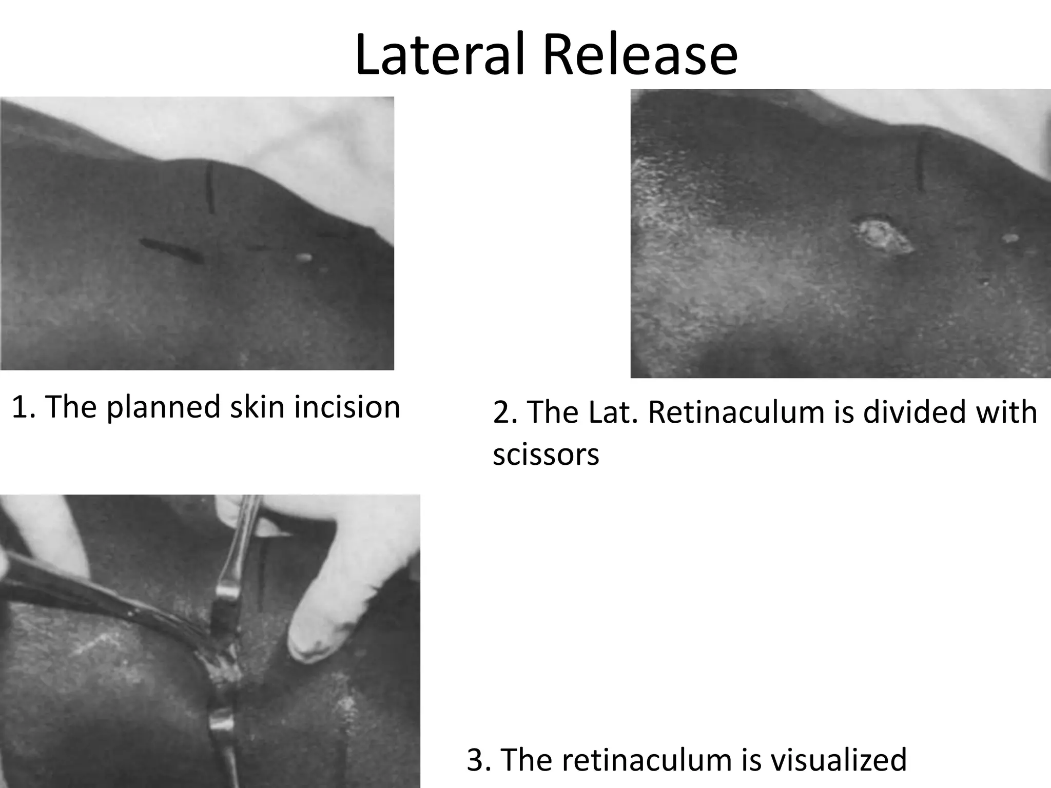 Lateral Release
1. The planned skin incision
3. The retinaculum is visualized
2. The Lat. Retinaculum is divided with
scissors
 