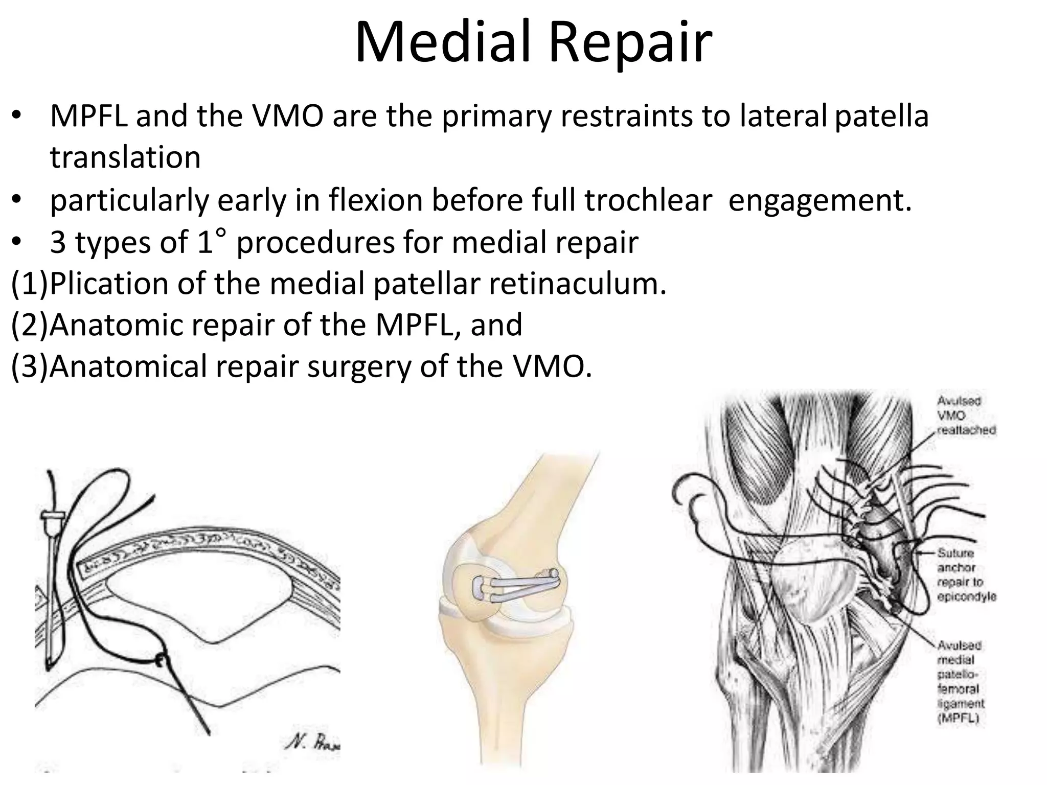 • MPFL and the VMO are the primary restraints to lateral patella
translation
• particularly early in flexion before full trochlear engagement.
• 3 types of 1° procedures for medial repair
(1)Plication of the medial patellar retinaculum.
(2)Anatomic repair of the MPFL, and
(3)Anatomical repair surgery of the VMO.
Medial Repair
 