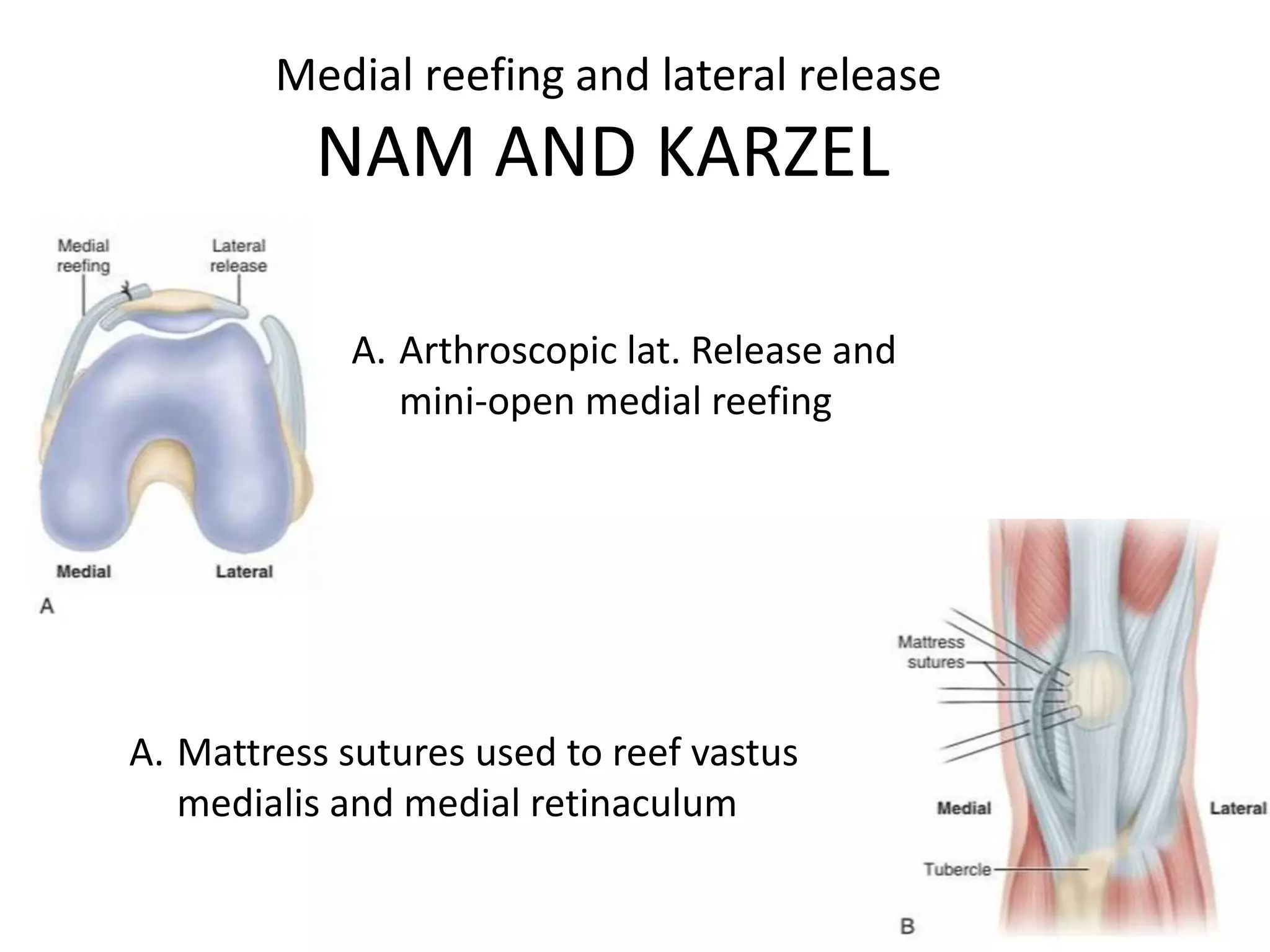 Medial reefing and lateral release
NAM AND KARZEL
A. Arthroscopic lat. Release and
mini-open medial reefing
A. Mattress sutures used to reef vastus
medialis and medial retinaculum
 
