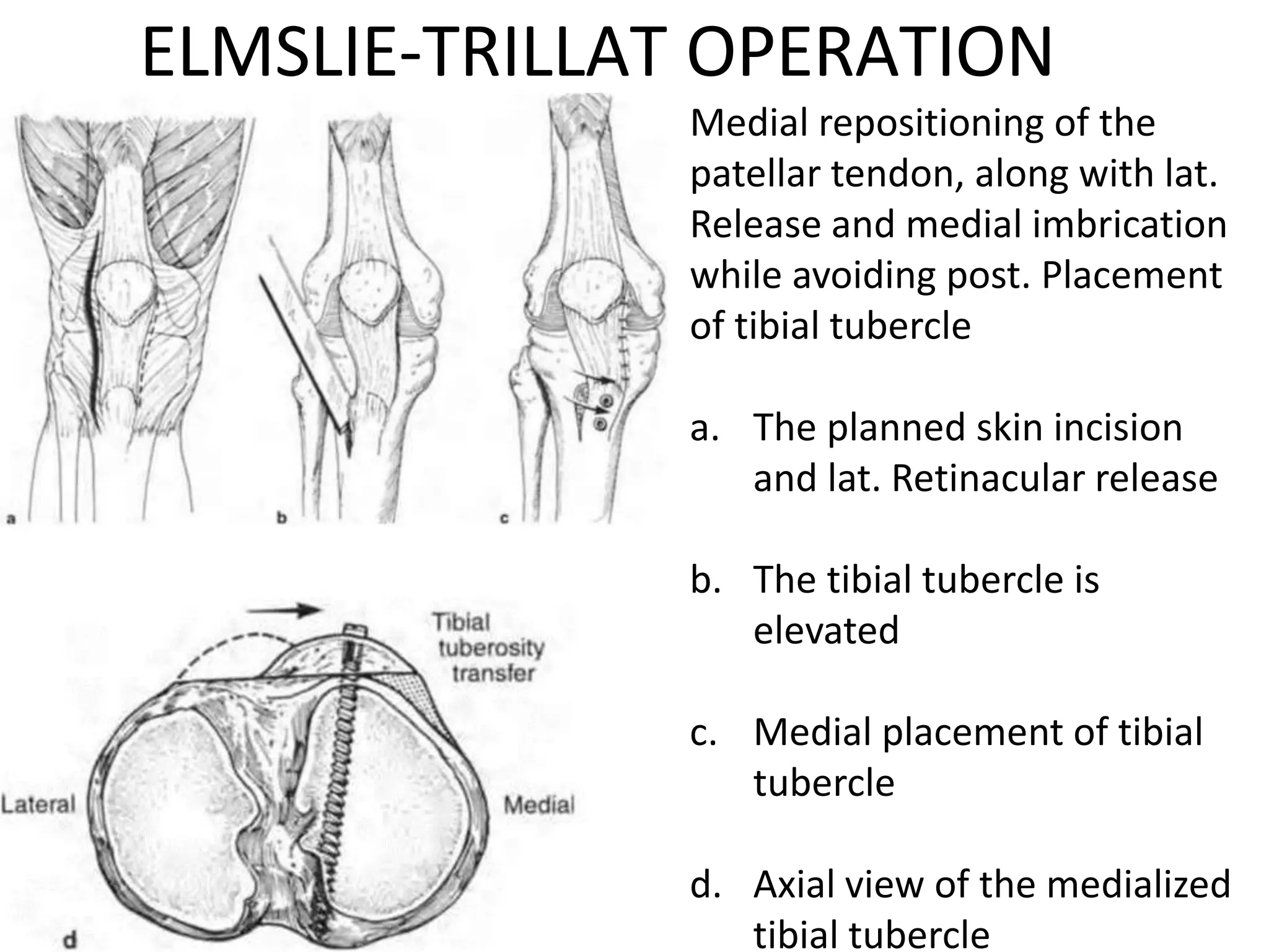ELMSLIE-TRILLAT OPERATION
Medial repositioning of the
patellar tendon, along with lat.
Release and medial imbrication
while avoiding post. Placement
of tibial tubercle
a. The planned skin incision
and lat. Retinacular release
b. The tibial tubercle is
elevated
c. Medial placement of tibial
tubercle
d. Axial view of the medialized
tibial tubercle
 