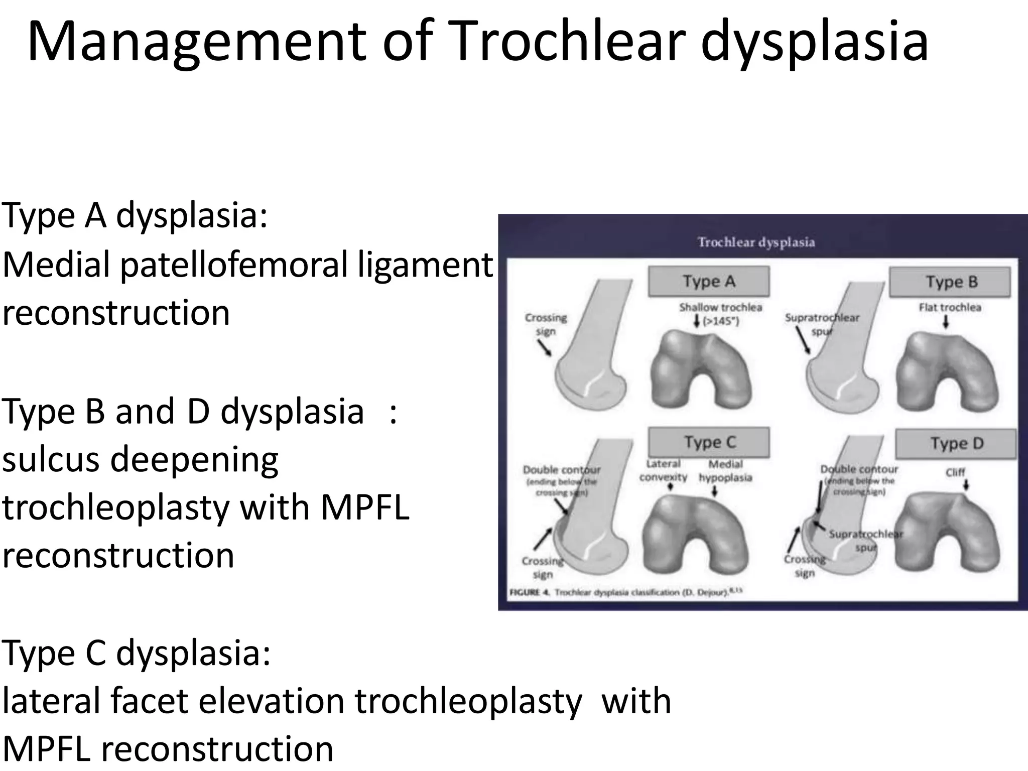 Type A dysplasia:
Medial patellofemoral ligament
reconstruction
Type B and D dysplasia :
sulcus deepening
trochleoplasty with MPFL
reconstruction
Type C dysplasia:
lateral facet elevation trochleoplasty with
MPFL reconstruction
Management of Trochlear dysplasia
 