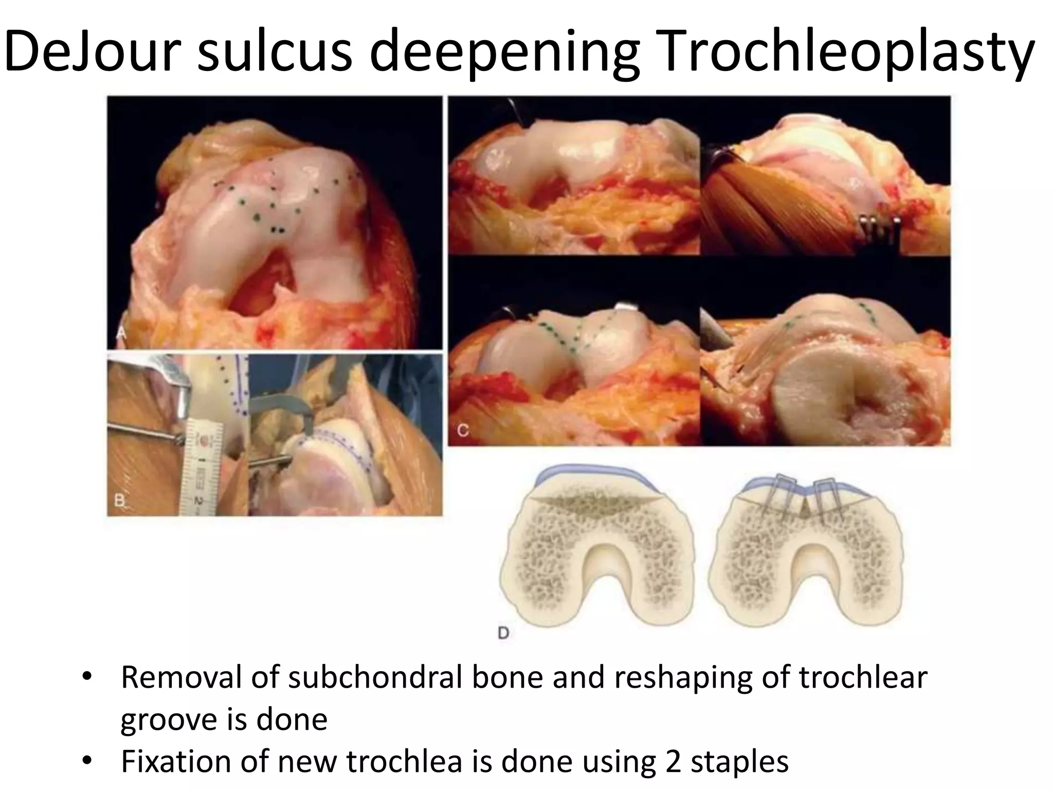 DeJour sulcus deepening Trochleoplasty
• Removal of subchondral bone and reshaping of trochlear
groove is done
• Fixation of new trochlea is done using 2 staples
 