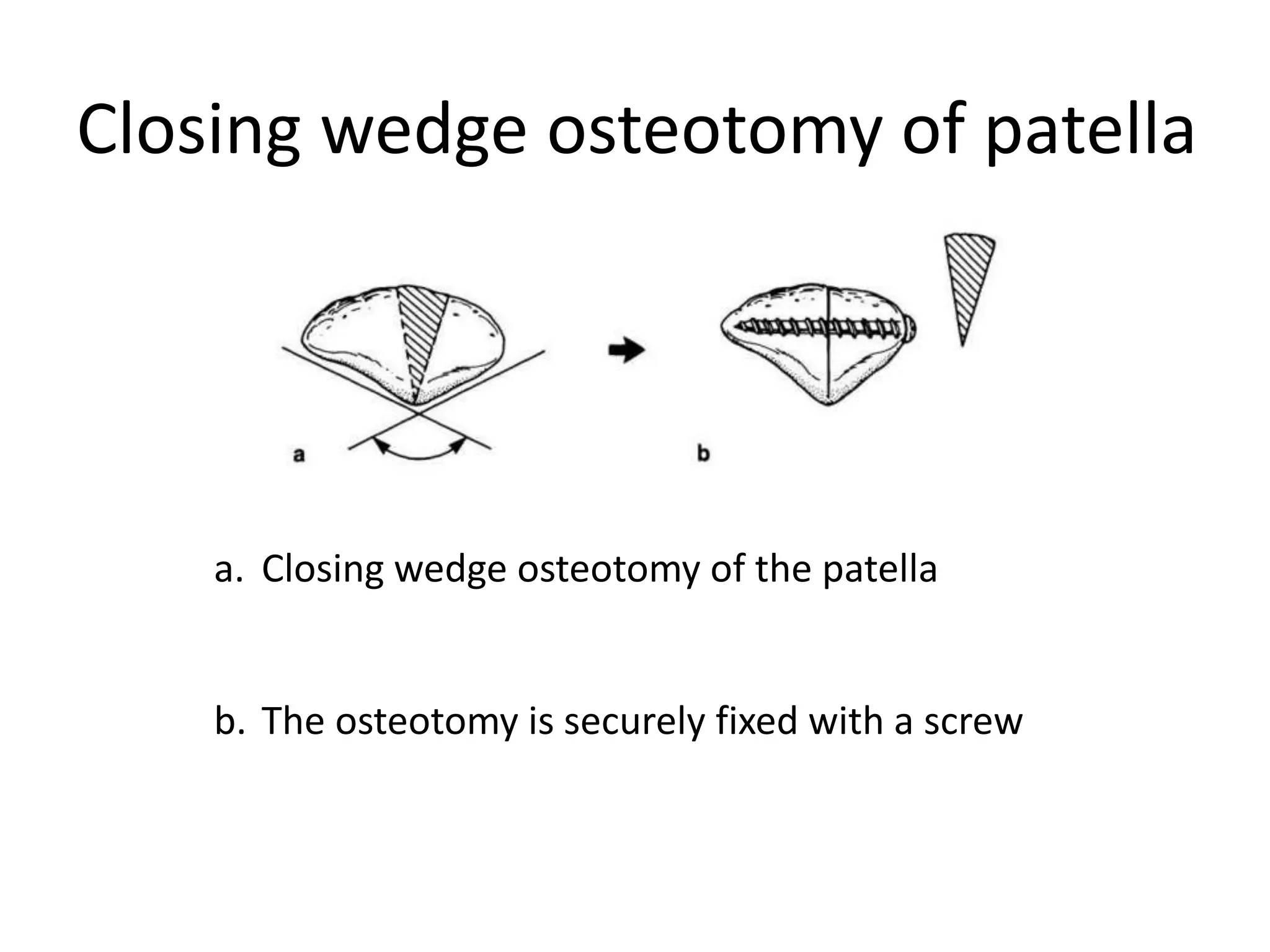 Closing wedge osteotomy of patella
a. Closing wedge osteotomy of the patella
b. The osteotomy is securely fixed with a screw
 