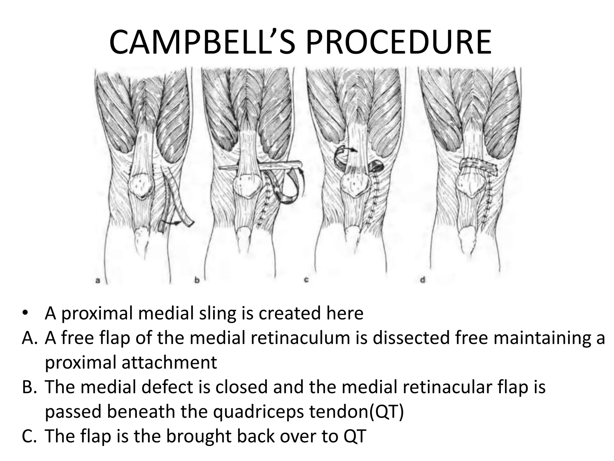CAMPBELL’S PROCEDURE
• A proximal medial sling is created here
A. A free flap of the medial retinaculum is dissected free maintaining a
proximal attachment
B. The medial defect is closed and the medial retinacular flap is
passed beneath the quadriceps tendon(QT)
C. The flap is the brought back over to QT
 