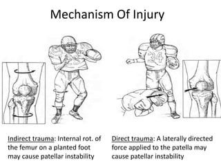 Mechanism Of Injury
Indirect trauma: Internal rot. of
the femur on a planted foot
may cause patellar instability
Direct trauma: A laterally directed
force applied to the patella may
cause patellar instability
 