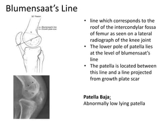 Blumensaat’s Line
• line which corresponds to the
roof of the intercondylar fossa
of femur as seen on a lateral
radiograph of the knee joint
• The lower pole of patella lies
at the level of blumensaat’s
line
• The patella is located between
this line and a line projected
from growth plate scar
Patella Baja:
Abnormally low lying patella
 