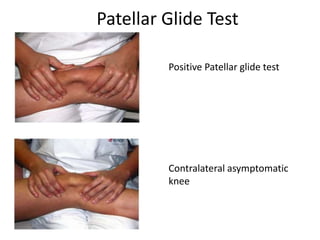 Patellar Glide Test
Positive Patellar glide test
Contralateral asymptomatic
knee
 