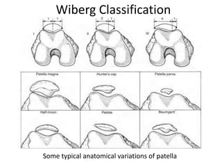 Wiberg Classification
Some typical anatomical variations of patella
 