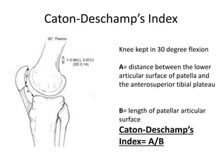 Caton-Deschamp’s Index
Knee kept in 30 degree flexion
A= distance between the lower
articular surface of patella and
the anterosuperior tibial plateau
B= length of patellar articular
surface
Caton-Deschamp’s
Index= A/B
 
