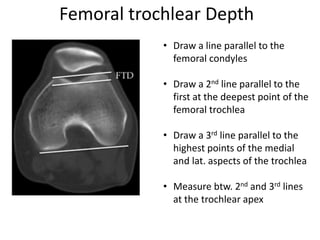 Femoral trochlear Depth
• Draw a line parallel to the
femoral condyles
• Draw a 2nd line parallel to the
first at the deepest point of the
femoral trochlea
• Draw a 3rd line parallel to the
highest points of the medial
and lat. aspects of the trochlea
• Measure btw. 2nd and 3rd lines
at the trochlear apex
 