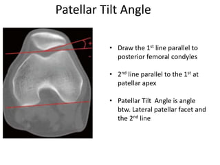 Patellar Tilt Angle
• Draw the 1st line parallel to
posterior femoral condyles
• 2nd line parallel to the 1st at
patellar apex
• Patellar Tilt Angle is angle
btw. Lateral patellar facet and
the 2nd line
 