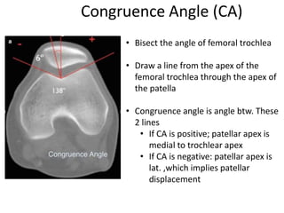 Congruence Angle (CA)
• Bisect the angle of femoral trochlea
• Draw a line from the apex of the
femoral trochlea through the apex of
the patella
• Congruence angle is angle btw. These
2 lines
• If CA is positive; patellar apex is
medial to trochlear apex
• If CA is negative: patellar apex is
lat. ,which implies patellar
displacement
 
