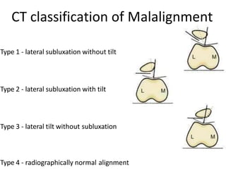 CT classification of Malalignment
Type 1 - lateral subluxation without tilt
Type 2 - lateral subluxation with tilt
Type 3 - lateral tilt without subluxation
Type 4 - radiographically normal alignment
 