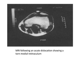 MRI following an acute dislocation showing a
torn medial retinaculum
 