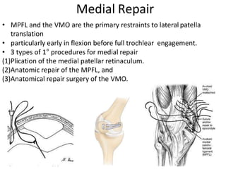 • MPFL and the VMO are the primary restraints to lateral patella
translation
• particularly early in flexion before full trochlear engagement.
• 3 types of 1° procedures for medial repair
(1)Plication of the medial patellar retinaculum.
(2)Anatomic repair of the MPFL, and
(3)Anatomical repair surgery of the VMO.
Medial Repair
 