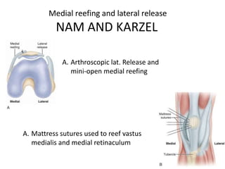 Medial reefing and lateral release
NAM AND KARZEL
A. Arthroscopic lat. Release and
mini-open medial reefing
A. Mattress sutures used to reef vastus
medialis and medial retinaculum
 