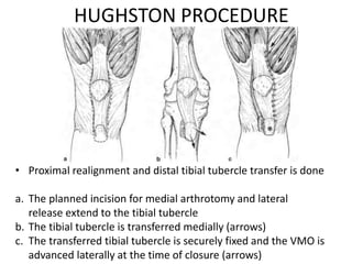 HUGHSTON PROCEDURE
• Proximal realignment and distal tibial tubercle transfer is done
a. The planned incision for medial arthrotomy and lateral
release extend to the tibial tubercle
b. The tibial tubercle is transferred medially (arrows)
c. The transferred tibial tubercle is securely fixed and the VMO is
advanced laterally at the time of closure (arrows)
 