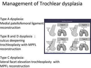 Type A dysplasia:
Medial patellofemoral ligament
reconstruction
Type B and D dysplasia :
sulcus deepening
trochleoplasty with MPFL
reconstruction
Type C dysplasia:
lateral facet elevation trochleoplasty with
MPFL reconstruction
Management of Trochlear dysplasia
 
