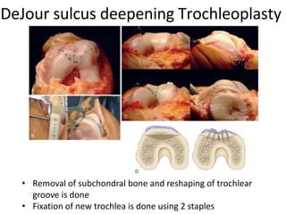 DeJour sulcus deepening Trochleoplasty
• Removal of subchondral bone and reshaping of trochlear
groove is done
• Fixation of new trochlea is done using 2 staples
 
