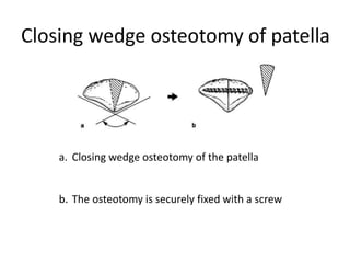 Closing wedge osteotomy of patella
a. Closing wedge osteotomy of the patella
b. The osteotomy is securely fixed with a screw
 