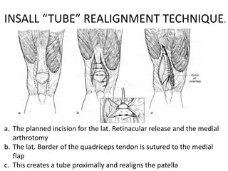 INSALL “TUBE” REALIGNMENT TECHNIQUE.
a. The planned incision for the lat. Retinacular release and the medial
arthrotomy
b. The lat. Border of the quadriceps tendon is sutured to the medial
flap
c. This creates a tube proximally and realigns the patella
 