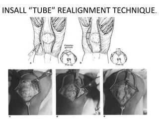 INSALL “TUBE” REALIGNMENT TECHNIQUE.
 