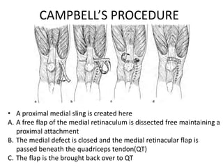 CAMPBELL’S PROCEDURE
• A proximal medial sling is created here
A. A free flap of the medial retinaculum is dissected free maintaining a
proximal attachment
B. The medial defect is closed and the medial retinacular flap is
passed beneath the quadriceps tendon(QT)
C. The flap is the brought back over to QT
 