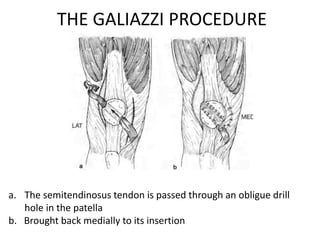 THE GALIAZZI PROCEDURE
a. The semitendinosus tendon is passed through an obligue drill
hole in the patella
b. Brought back medially to its insertion
 