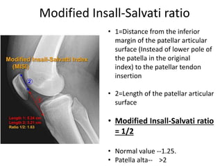 Recurrent Patellar Dislocation PPT recurrent-patellar-dislocation-ppt