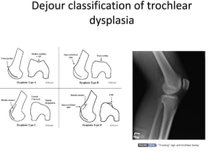 Recurrent Patellar Instability | PPTX