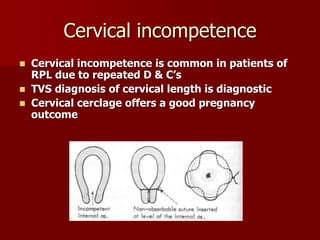 Cervical incompetence
 Cervical incompetence is common in patients of
RPL due to repeated D & C’s
 TVS diagnosis of cervical length is diagnostic
 Cervical cerclage offers a good pregnancy
outcome
 