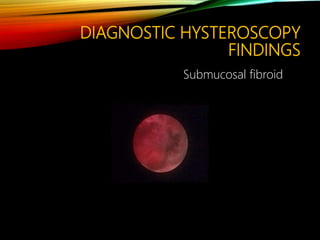 DIAGNOSTIC HYSTEROSCOPY
FINDINGS
Submucosal fibroid
 
