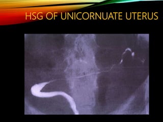 HSG OF UNICORNUATE UTERUS
 